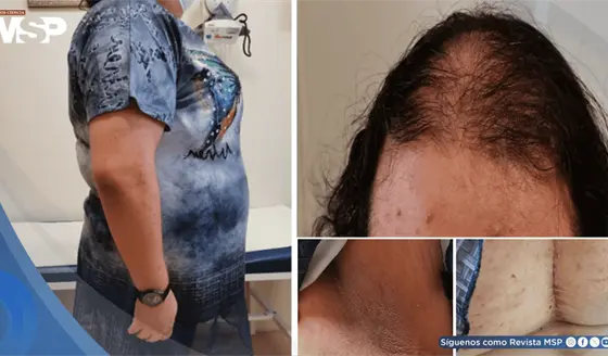 Síndrome HAIR-AN en adolescente con resistencia a insulina e hiperandrogenismo por ovario poliquístico