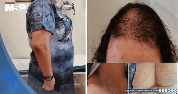 Síndrome HAIR-AN en adolescente con resistencia a insulina e hiperandrogenismo por ovario poliquístico