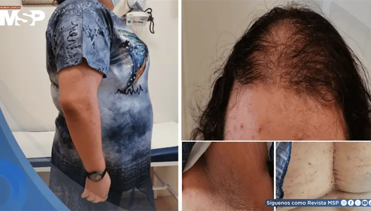 Síndrome HAIR-AN en adolescente con resistencia a insulina e hiperandrogenismo por ovario poliquístico Síndrome HAIR-AN en adolescente con resistencia a insulina e hiperandrogenismo por ovario poliquístico