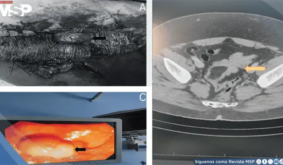 Dolor abdominal "intermitente" resultó ser un lipoma gigante del colon sigmoide que causó intususcepción