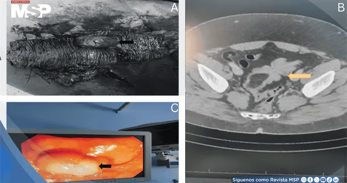 Dolor abdominal "intermitente" resultó ser un lipoma gigante del colon sigmoide que causó intususcepción