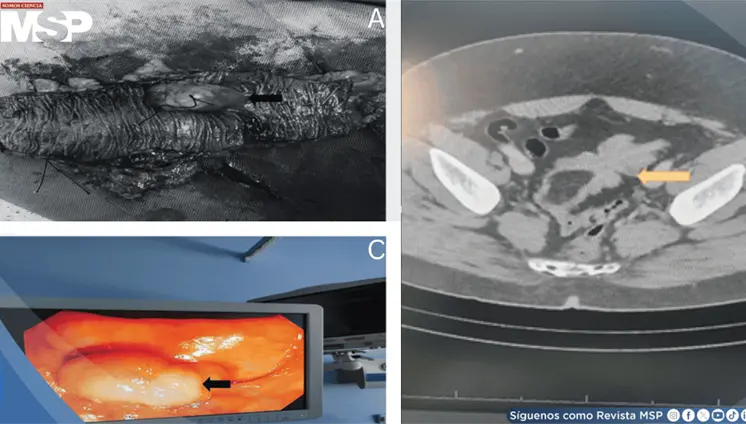 Dolor abdominal "intermitente" resultó ser un lipoma gigante del colon sigmoide que causó intususcepción Dolor abdominal "intermitente" resultó ser un lipoma gigante del colon sigmoide que causó intususcepción