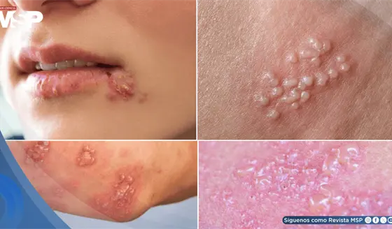 Así puede verse el herpes en mujeres: Síntomas, tratamiento y cuándo consultar al médico