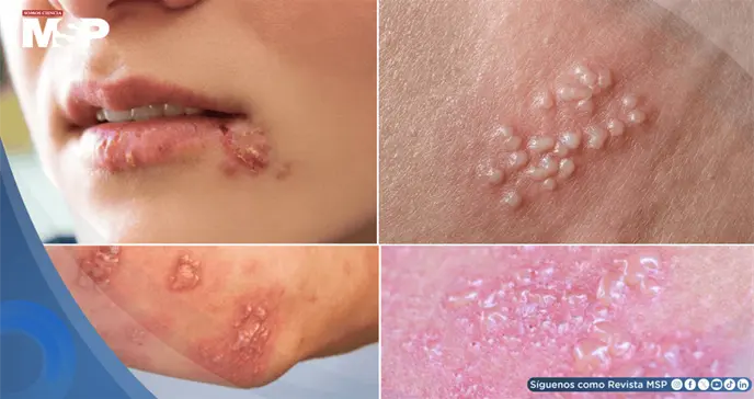 Así puede verse el herpes en mujeres: Síntomas, tratamiento y cuándo consultar al médico