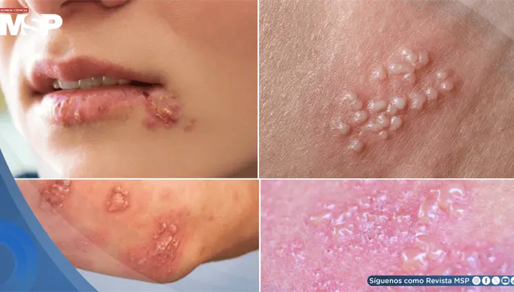 Así puede verse el herpes en mujeres: Síntomas, tratamiento y cuándo consultar al médico
