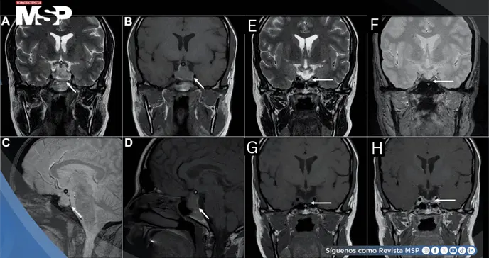 Cefalea posparto atribuida a punción dural terminó siendo una apoplejía hipofisaria hemorrágica