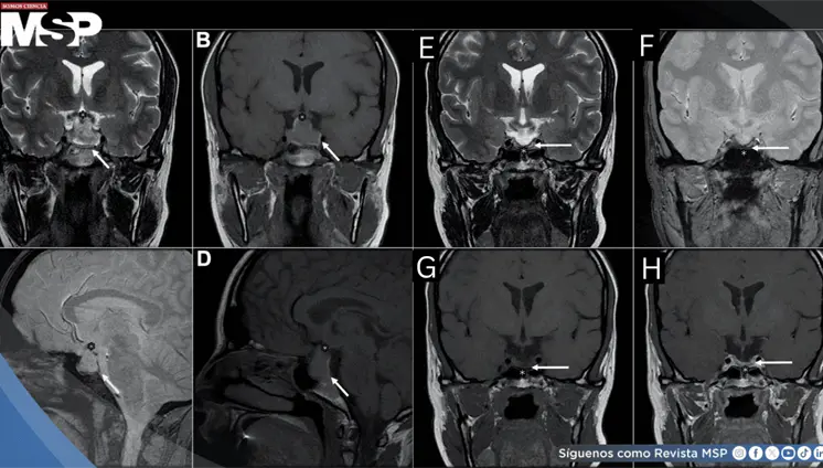 Cefalea posparto atribuida a punción dural terminó siendo una apoplejía hipofisaria hemorrágica Cefalea posparto atribuida a punción dural terminó siendo una apoplejía hipofisaria hemorrágica