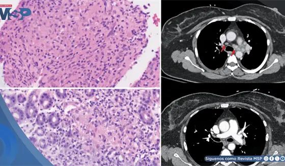 Reacción inflamatoria tipo sarcoide asociada a pembrolizumab en mujer con cáncer de mama imitó metástasis