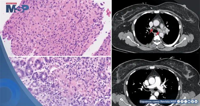 Reacción inflamatoria tipo sarcoide asociada a pembrolizumab en mujer con cáncer de mama imitó metástasis