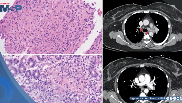 Reacción inflamatoria tipo sarcoide asociada a pembrolizumab en mujer con cáncer de mama imitó metástasis