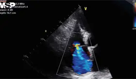 Describen signos cardiopulmonares e inflamatorios asociados a escorbuto por deficiencia vitamínica