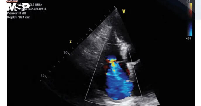Describen signos cardiopulmonares e inflamatorios asociados a escorbuto por deficiencia vitamínica Describen signos cardiopulmonares e inflamatorios asociados a escorbuto por deficiencia vitamínica