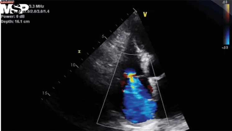 Describen signos cardiopulmonares e inflamatorios asociados a escorbuto por deficiencia vitamínica
