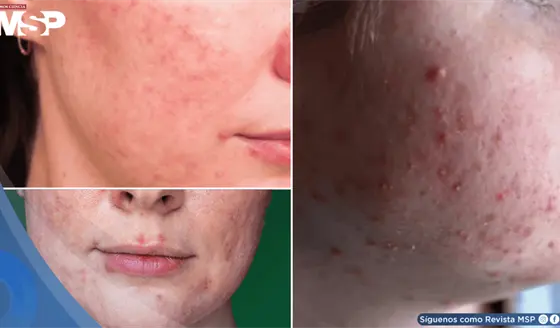 Rosácea papulopustular: brotes inflamatorios se confundirían con acné grave ¿Qué lo desencadena? 