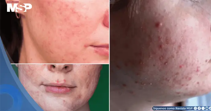 Rosácea papulopustular: brotes inflamatorios se confundirían con acné grave ¿Qué lo desencadena? 