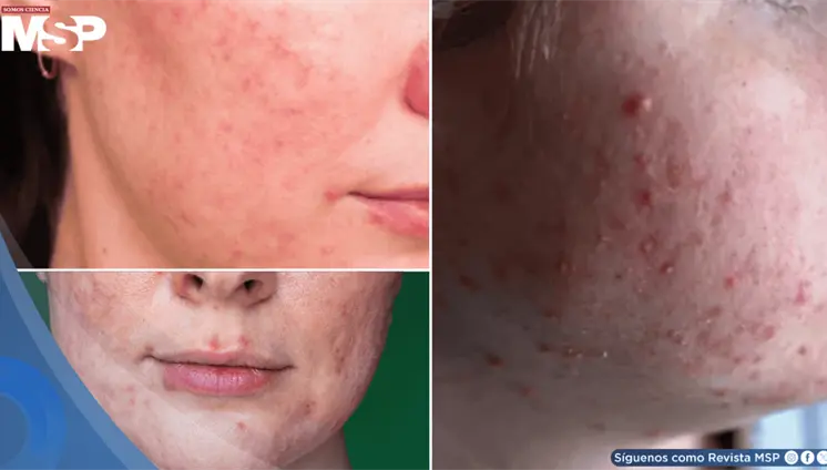 Rosácea papulopustular: brotes inflamatorios se confundirían con acné grave ¿Qué lo desencadena? 
