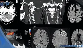Vértigo inducido por parpadeo en un paciente con microinfarto en la unión parieto-occipital