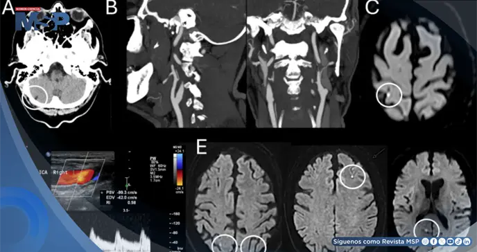 Vértigo inducido por parpadeo en un paciente con microinfarto en la unión parieto-occipital Vértigo inducido por parpadeo en un paciente con microinfarto en la unión parieto-occipital