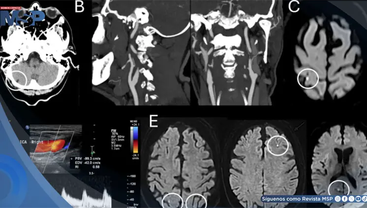 Vértigo inducido por parpadeo en un paciente con microinfarto en la unión parieto-occipital