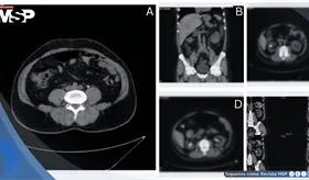Stent ureteral anudado e incrustado tras retención prolongada en paciente con litiasis e hidronefrosis
