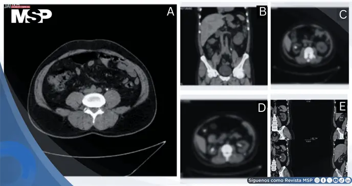 Stent ureteral anudado e incrustado tras retención prolongada en paciente con litiasis e hidronefrosis