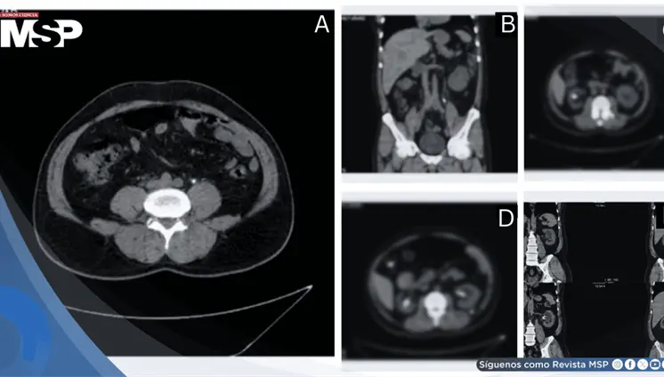 Stent ureteral anudado e incrustado tras retención prolongada en paciente con litiasis e hidronefrosis Stent ureteral anudado e incrustado tras retención prolongada en paciente con litiasis e hidronefrosis