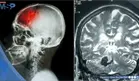 ´Falsos ictus´ en niños: Crisis epilépticas o migrañas podrían imitar un accidente cerebrovascular