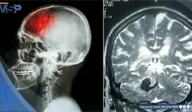 ´Falsos ictus´ en niños: Crisis epilépticas o migrañas podrían imitar un accidente cerebrovascular