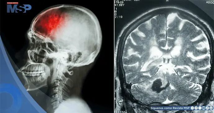 ´Falsos ictus´ en niños: Crisis epilépticas o migrañas podrían imitar un accidente cerebrovascular