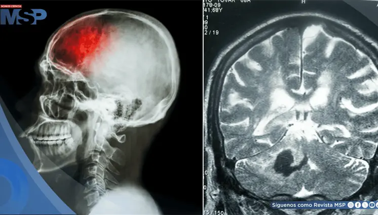 ´Falsos ictus´ en niños: Crisis epilépticas o migrañas podrían imitar un accidente cerebrovascular