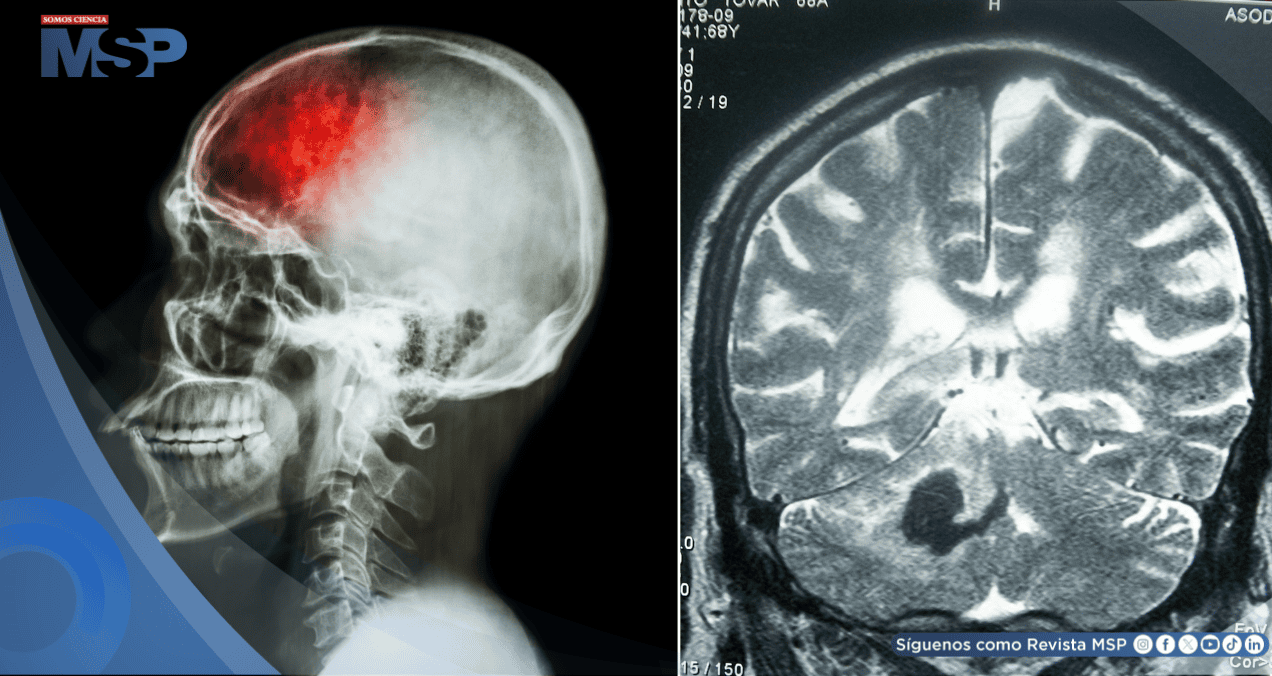 ‘Falsos ictus’ en niños: Crisis epilépticas o migrañas podrían imitar un accidente cerebrovascular ‘Falsos ictus’ en niños: Crisis epilépticas o migrañas podrían imitar un accidente cerebrovascular