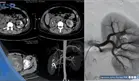 Fístula arteriovenosa renal provocó hemorragia severa y recurrentes en una mujer de 34 años con debilidad