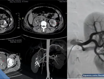 Fístula arteriovenosa renal provocó hemorragia severa y recurrentes en una mujer de 34 años con debilidad