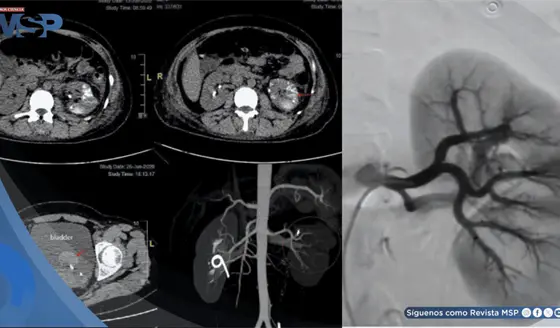 Fístula arteriovenosa renal provocó hemorragia severa y recurrentes en una mujer de 34 años con debilidad