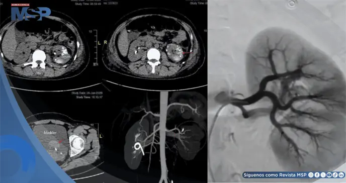 Fístula arteriovenosa renal provocó hemorragia severa y recurrentes en una mujer de 34 años con debilidad