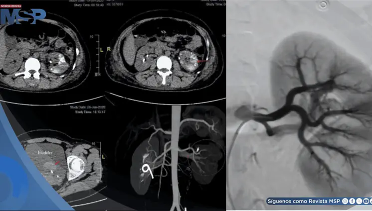Fístula arteriovenosa renal provocó hemorragia severa y recurrentes en una mujer de 34 años con debilidad