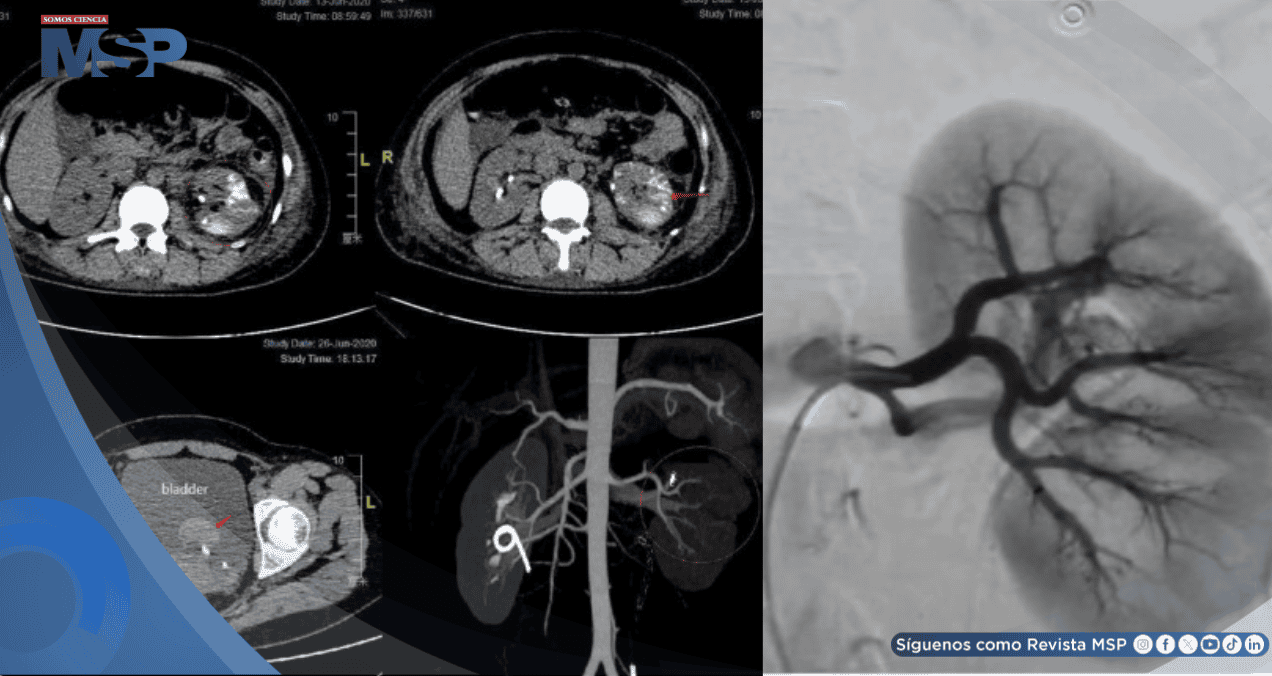 Fístula arteriovenosa renal provocó hemorragia severa y recurrentes en una mujer de 34 años con debilidad