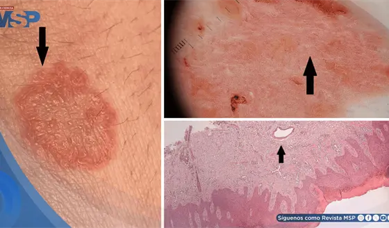 Eccema "inofensivo" revela hepatitis C crónica oculta por 20 años tras una transfusión de sangre 