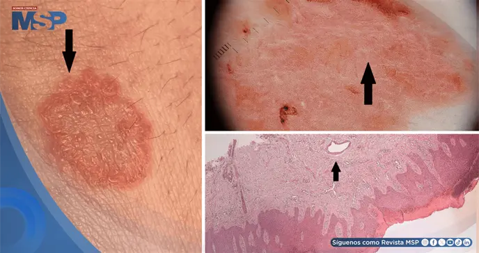 Eccema "inofensivo" revela hepatitis C crónica oculta por 20 años tras una transfusión de sangre Eccema "inofensivo" revela hepatitis C crónica oculta por 20 años tras una transfusión de sangre