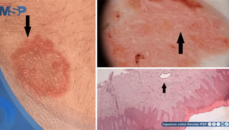 Eccema "inofensivo" revela hepatitis C crónica oculta por 20 años tras una transfusión de sangre Eccema "inofensivo" revela hepatitis C crónica oculta por 20 años tras una transfusión de sangre