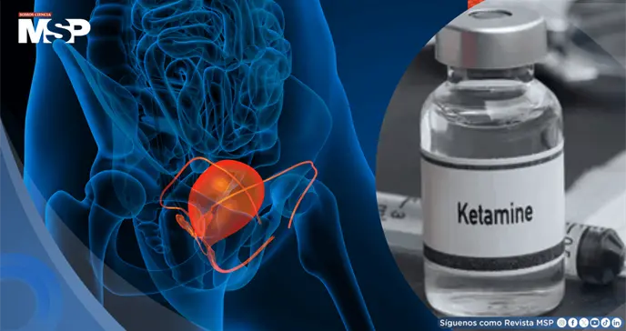 Adicción a la ketamina obliga a jóvenes de 19 años a someterse a cirugías de vejiga Adicción a la ketamina obliga a jóvenes de 19 años a someterse a cirugías de vejiga