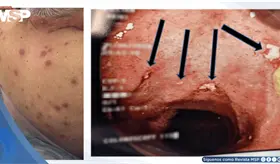 Síndrome de Sweet con erupciones cutáneas como manifestación inicial de Enfermedad de Crohn ileocecal