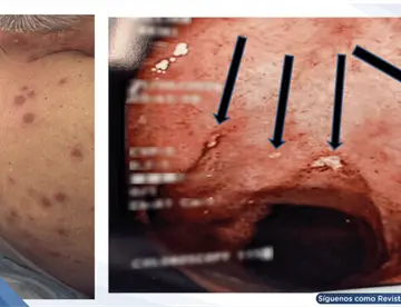 Síndrome de Sweet con erupciones cutáneas como manifestación inicial de Enfermedad de Crohn ileocecal