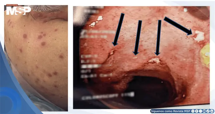 Síndrome de Sweet con erupciones cutáneas como manifestación inicial de Enfermedad de Crohn ileocecal