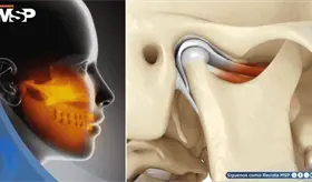 ¿Dolor en mandíbula, oído o cabeza? Podría deberse a la articulación temporomandibular y no a migrañas