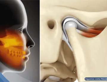 ¿Dolor en mandíbula, oído o cabeza? Podría deberse a la articulación temporomandibular y no a migrañas
