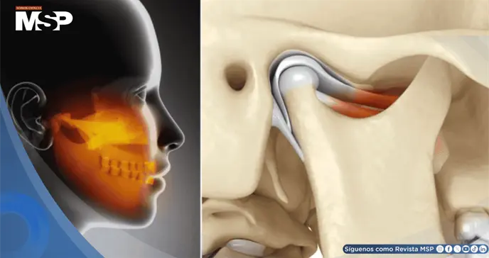 ¿Dolor en mandíbula, oído o cabeza? Podría deberse a la articulación temporomandibular y no a migrañas ¿Dolor en mandíbula, oído o cabeza? Podría deberse a la articulación temporomandibular y no a migrañas