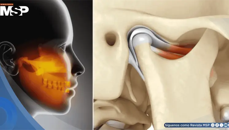 ¿Dolor en mandíbula, oído o cabeza? Podría deberse a la articulación temporomandibular y no a migrañas ¿Dolor en mandíbula, oído o cabeza? Podría deberse a la articulación temporomandibular y no a migrañas