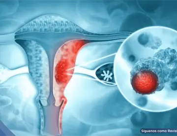Fármaco para el asma complementaría el tratamiento de cáncer de ovario al superar barreras inmunitarias