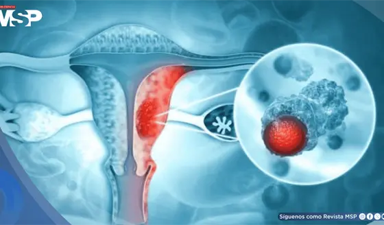 Fármaco para el asma complementaría el tratamiento de cáncer de ovario al superar barreras inmunitarias